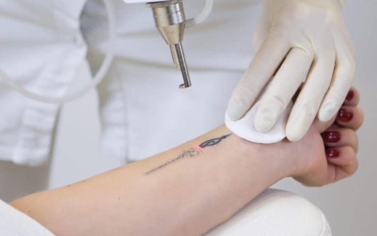 What to Expect in Tattoo Removal Costs