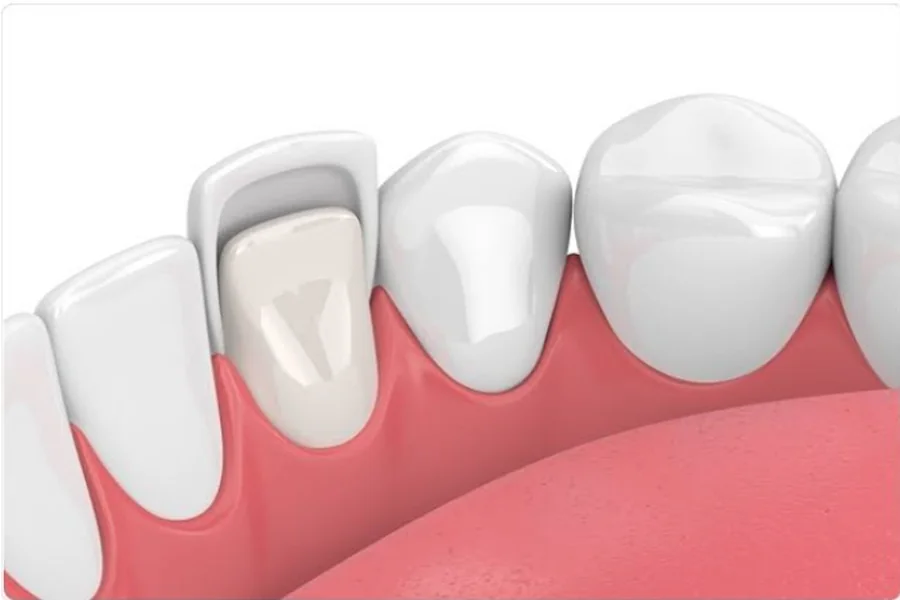 The Process of Getting Dental Veneers: What to Expect