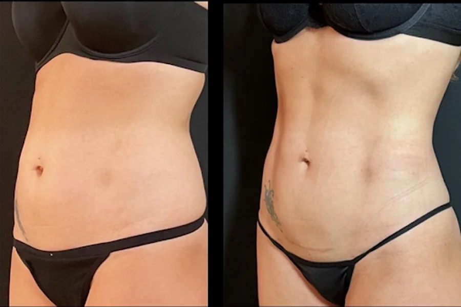 Tummy Tuck Abroad What You Need to Know Before You Book Anything